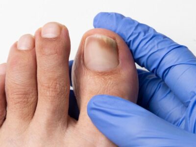 Clear Nails Fast! Nail Fungus Treatment at Cosmetic Clinic Coolangatta