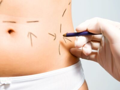 Can Liposuction Cost in Dubai Create Harmonious and Radiant Body Lines?