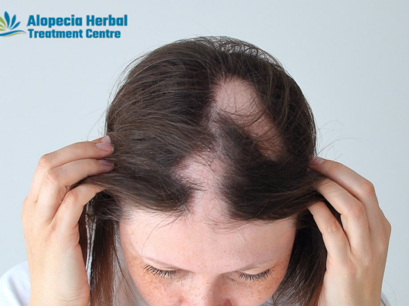 Alopecia Herbal Treatment Centre: Specialized Alopecia Areata Treatment in Noida